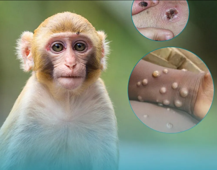 Bộ Y tế cho biết tiếp tục chủ động triển khai các giải pháp phòng, chống dịch đậu mùa khỉ trong thời gian tới